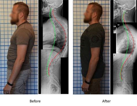 Case Study Kyphosis Treatment In Adults Before And After