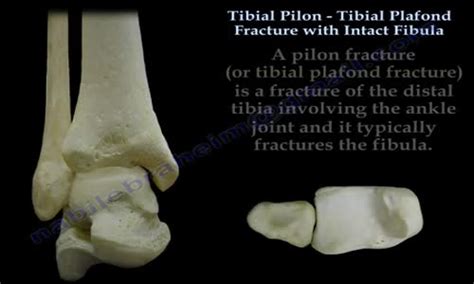 Tibial Pilon Fracture With Intact Fibula Everything You Need To Know Dr