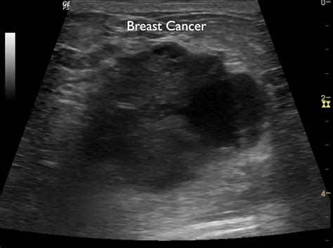 What Does Throat Cancer Look Like On An Ultrasound 10 Signs Of Throat