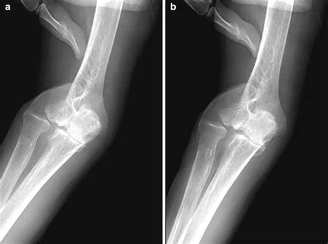 Stress Examination Under Fluoroscopy A Valgus And B Varus Stress The