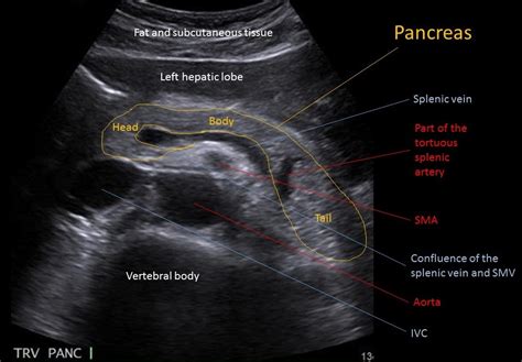 Sinceramente Esfera Submarino Pancreas Ultrasound Anatomy Erradicar