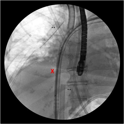 Crescent Cannula Red X Is Advanced Under Fluoroscopic And