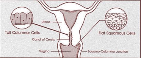 3 Cervical Vaginal Vulvar Disorders Flashcards Quizlet
