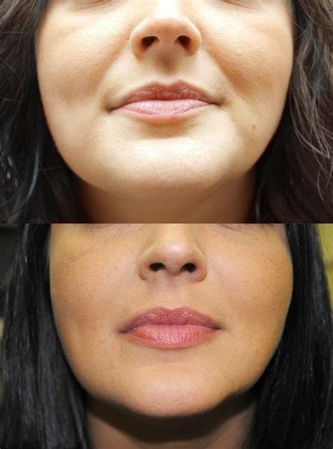 Juvederm Before And After Picture For The Nasolabial Fold Area Facial