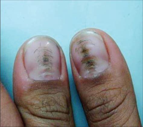 Nail Tic Disorders Manifestations Pathogenesis And Management
