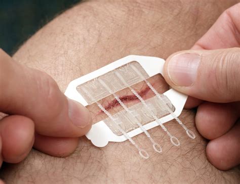 Zipstitch Is A Wound Closure Device That Works In Seconds