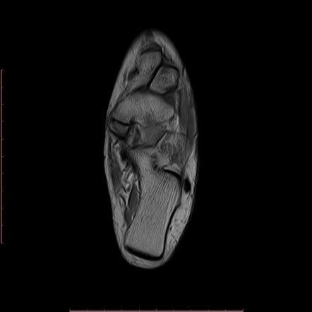 Accessory Navicular Syndrome Radiology Reference Article