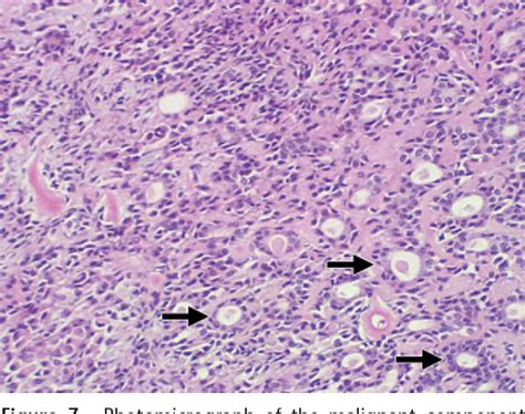 Figure 1 From Malignant Mixed Tumor Of The Hard Palate Semantic Scholar