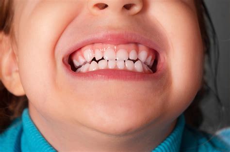 Children embarrassed to smile because of their teeth - Dentistry.co.uk