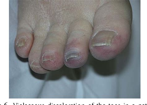 Figure 6 From Blue Toe Syndrome From Decreased Arterial Perfusion
