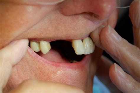 Replacing Missing Teeth With Bridges Riverside Dental Practice