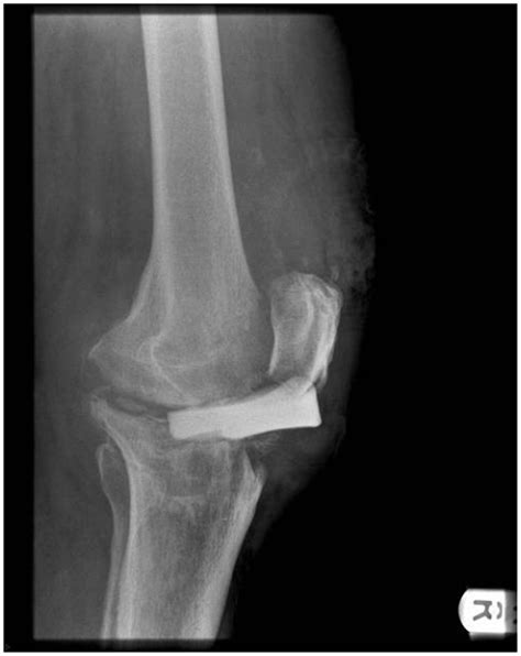 Frontiers Patella Tendon Injuries Secondary To Cement Spacers Used At First Stage Revision Of
