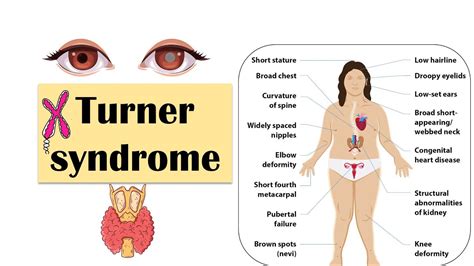 Turner Syndrome Causes Clinical Features Diagnosis Evaluation