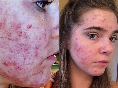 Youtube Stars Who Battled Acne Say They Cleared Skin Through A Low Fat