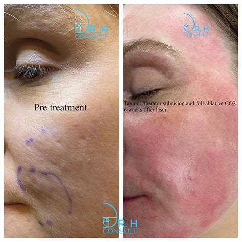 Fully Ablative Co Laser Resurfacing Treatment Dr H Consult