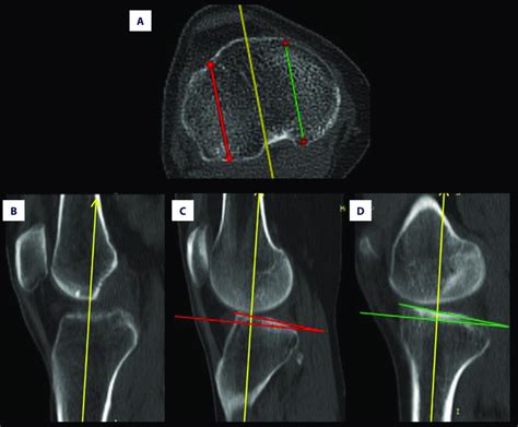 Measurement Of The Posterior Tibia Slope A First Transverse Computed