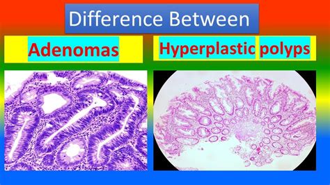 Difference Between Adenomas And Hyperplastic Polyps Youtube