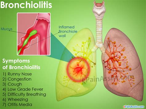 Bronchiolitis Treatment Home Remedies Prevention Causes