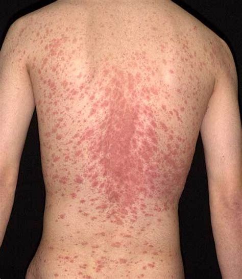 About Health Pityriasis Rosea