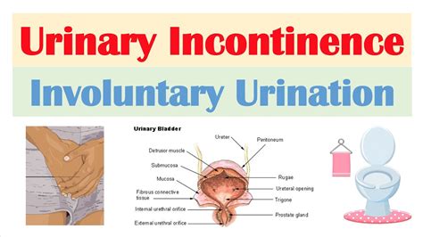 Download What Is Urinary Incontinence Causes Symptoms And