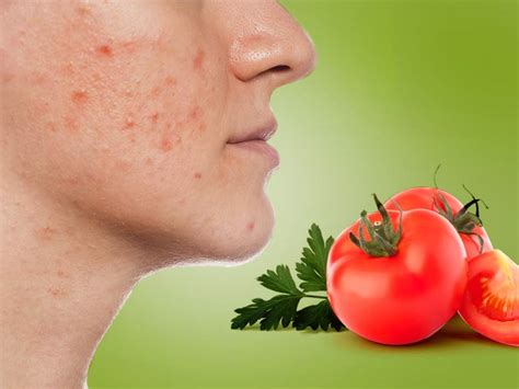 Red Spots On Skin How Does Tomato Help To Get Rid Of Red