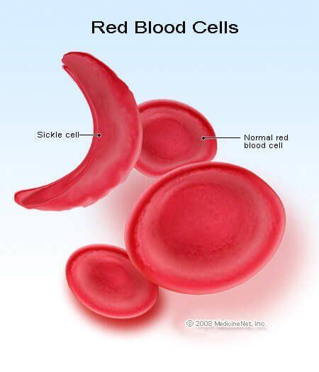 Picture Of Sickle Cell Red Blood Cell And Healthy Red Blood Cells