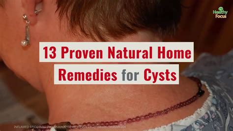 13 Proven Natural Home Remedies For Cyst Youtube