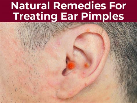 10 Effective Natural Remedies For Treating Ear Pimples