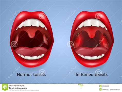 Tonsillitis Cartoon
