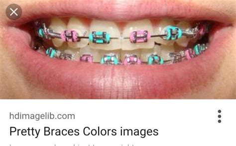Braces Colors Teal And Pink Shauna Gunter
