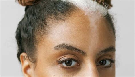 35 Belles Femmes Atteintes De Vitiligo Photographiées Par Un