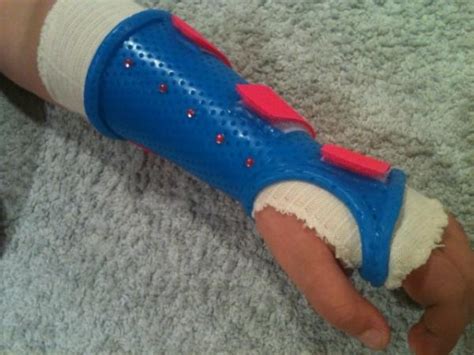 Splints And Casts Melbourne Hand Surgery