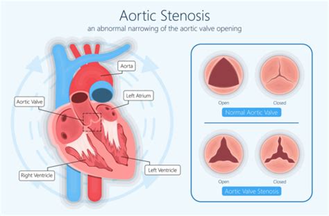 Aortic Valve Stenosis Symptoms Diagnosis Treatment In Hyderabad