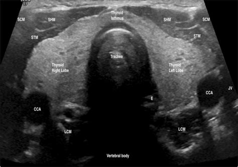 The Sonographic Characteristics Exhibited By A Normal Thyroid Us