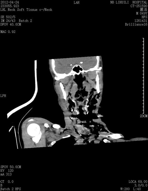 Ct Scan Of The Neck Showing Disruption Of The Cervical Trachea And