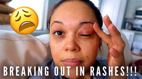 Breaking Out In Rashes Shannamariebvlogs Youtube