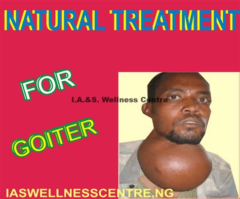 Goiter And Its Natural Treatment In Nigeria Ias Wellness Centre