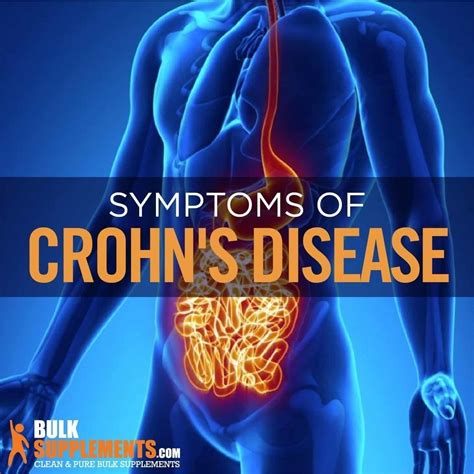 Tablo Read Crohns Disease Symptoms Causes And Treatment By