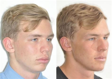 Case 3 Lower Jaw Surgery And Genioplasty Sydney Oral And Facial Surgery