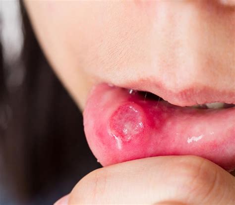 How To Use Honey To Heal Canker Sores
