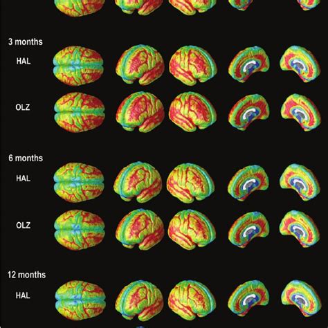 Progressive Gray Matter Loss After Year Statistical Maps Show The