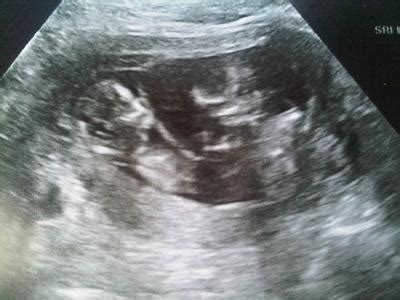 12 weeks pregnant, baby development, baby size, what does 12 week pregnancy look like, ultrasound, signs and symptoms. 12 Weeks Twin Ultrasound