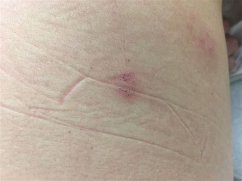 Varicella zoster meningitis: an atypical case of zoster reactivation in