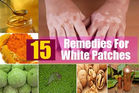 Best 15 Home Remedies For White Patches Natural Treatments And Cure For