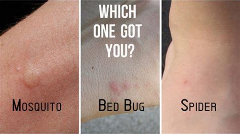 Bed Bug Rash Pictures Medical Pictures And Images 2023 Updated