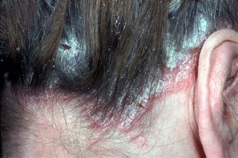 “scalp Psoriasis Is Something That Many People Suffer From”