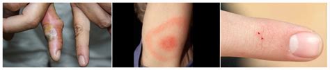 Black widows typically have some sort of red marking on their abdomens, but not always. Black Widow Spider Bite: Symptoms and Treatments | New ...