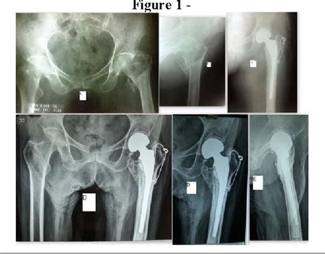 Figure 1 From Role Of Cemented Bipolar Hemiarthroplasty For Comminuted