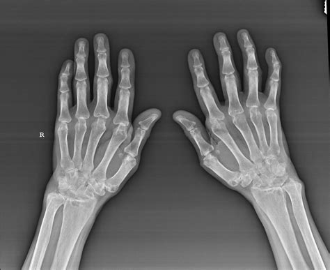 X Ray Hand Bones