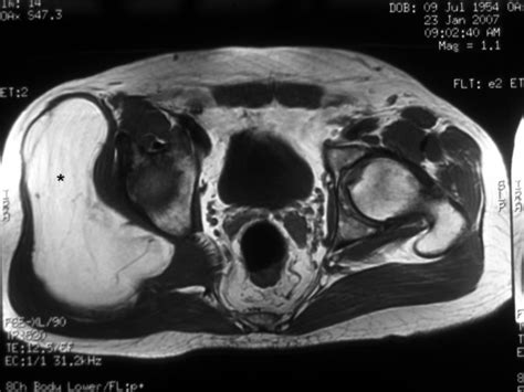 Magnetic Resonance Imaging Showing The Giant Lipoma Underneath The